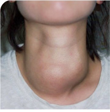 Thyroid nodule before RFA