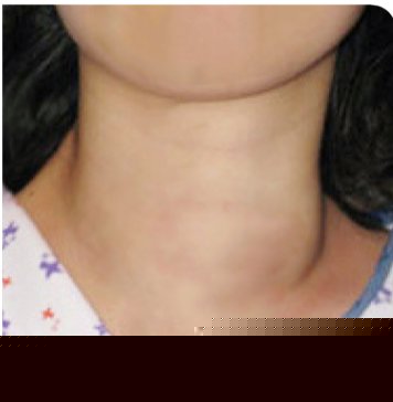 Thyroid nodule after RFA