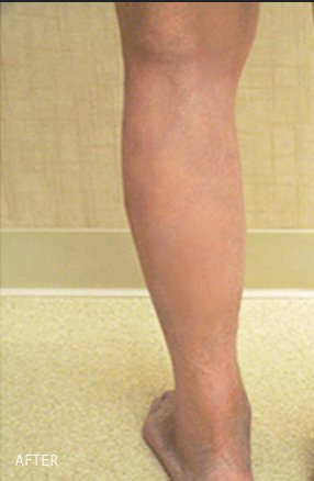 Varicose veins after treatment