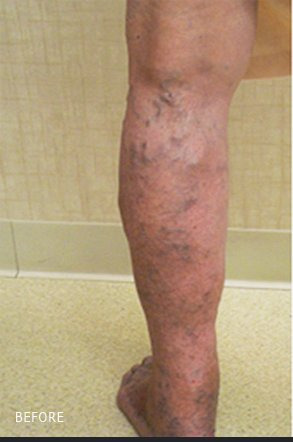 Varicose veins before treatment